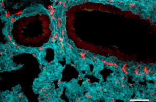 A research redefines the role of neutrophils and opens new avenues for cancer and inflammation therapies