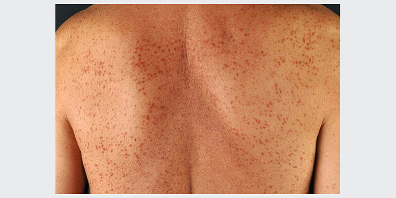 Typical skin lesions in mastocytosis. A study from the University of Basel shows