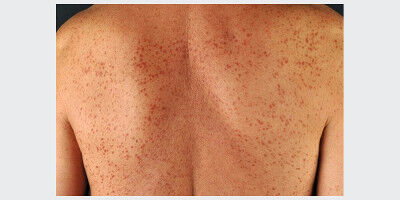 AI helps to evaluate skin lesions in rare disease more accurately