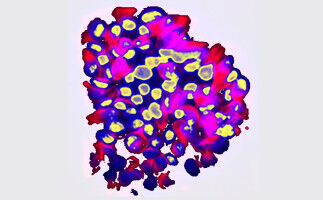 An AI to predict the risk of cancer metastases