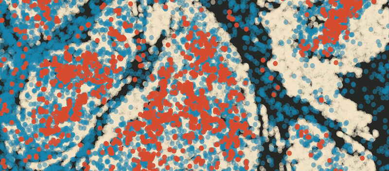 Tumour containing infiltrating neutrophils. In light grey, tumour cells. Among t