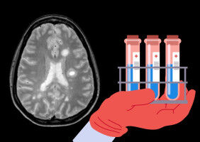 New diagnostic markers for multiple sclerosis discovered in cerebrospinal fluid