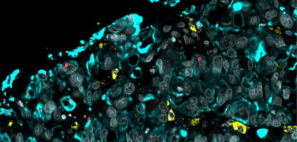 Why some oesophageal cancers are so hard to treat