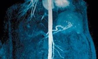 £2.1 million for kidney transplant study