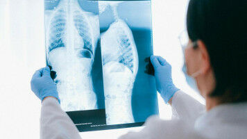 A cantonal screening to prevent lung cancer