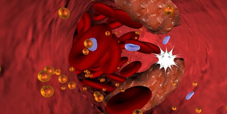 Atherosclerosis: Oxidative stress produces fatty acids, which cause inflammation