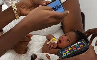 App detecting jaundice in babies a success in first major clinical trial