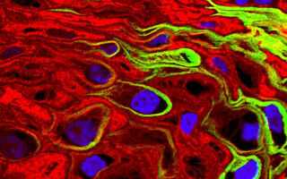 Better use of existing drugs increases cervical cancer survival and reduces recurrence