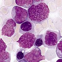 Centre of Excellence in blood cancer research unveiled in Cambridge