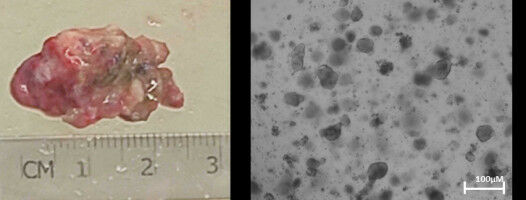 Creating Personalized Cancer Treatments Using 'Mini-Tumors' and a Digital Twin