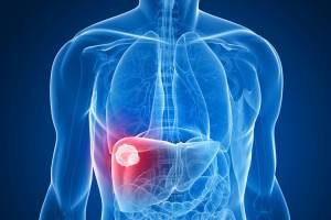 Drug sponge could minimize side effects of cancer treatment