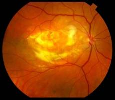 It's never too late to quit smoking and save your vision, UCLA study of elderly women finds