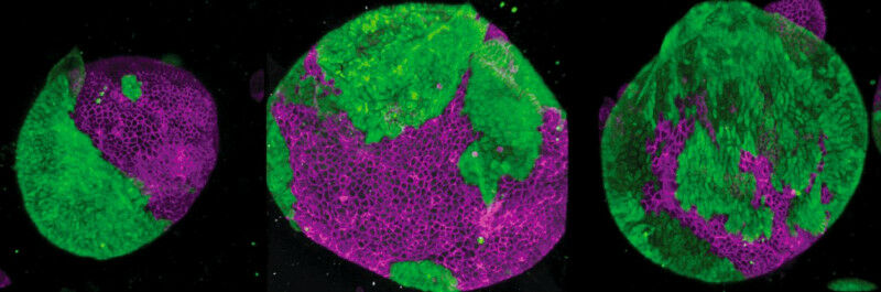 Organoids consisting of bile duct cells (purple) and intestinal cancer cells (gr