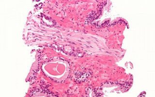 New combination of old drugs improves survival of prostate cancer