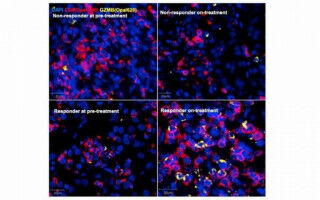 New immunotherapy insights for kidney cancer