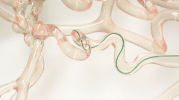 New real-time guidable-tip wire for surgically treating strokes