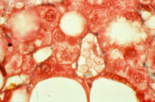 Persistence of severe hepatic fibrosis despite substantial weight loss with bariatric surgery