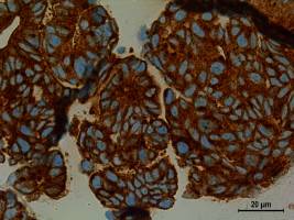 Significant vulnerability in prostate cancer detected