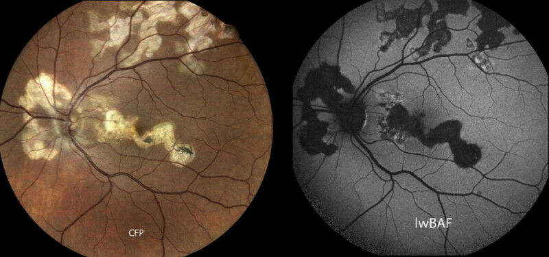 The picture shows an eye affected by the rare serpiginous chorioretinopathy. - T