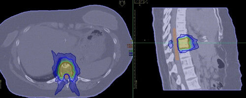 Targeting BCL3 to treat prostate cancer