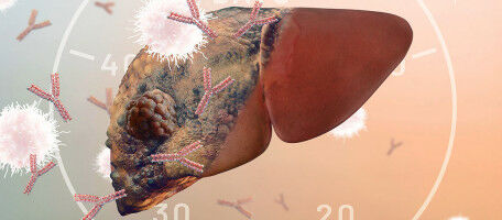 Transplantation combined with immunotherapy to cure liver cancer