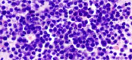 Trial confirms dual benefits of drug for multiple myeloma