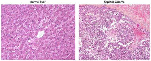 Tumor metabolism helps classify hepatoblastoma