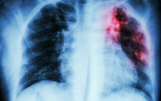 UCL institute named UK's first WHO Collaborating Centre for Tuberculosis
