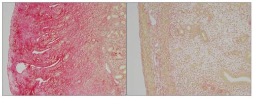 Uncovering the biology of a painful and disfiguring pediatric disease