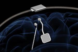 Wireless 'pacemaker for the brain' could be new standard treatment for neurological disorders