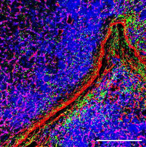 Immunofluorescence image of an extramedullary lesion of multiple myeloma, i.e. a