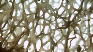 Genetic observation reveals a bone-weakening mechanism